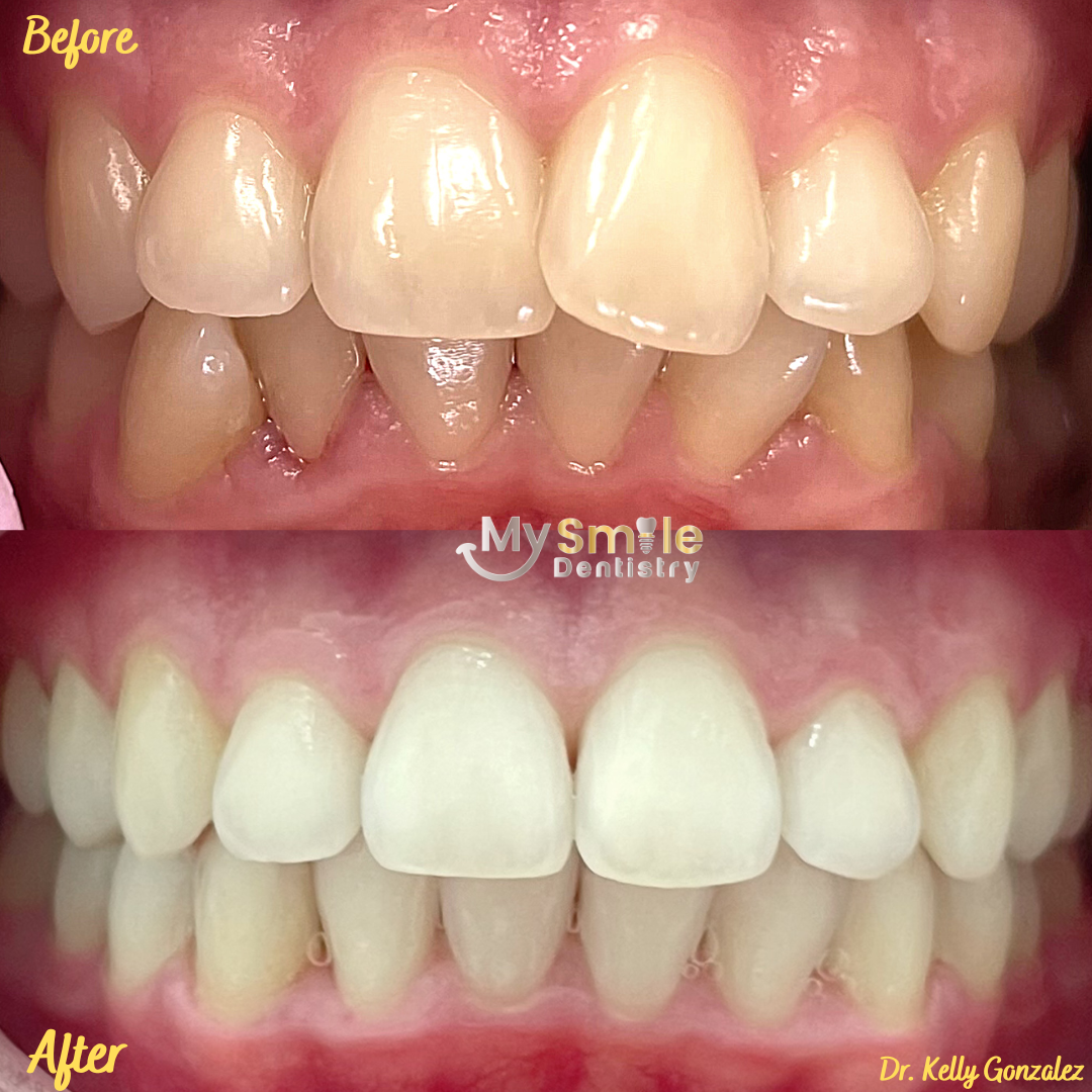 My Smile Dentistry | Implant-Supported Dentures, Sedation Dentistry and Sealants