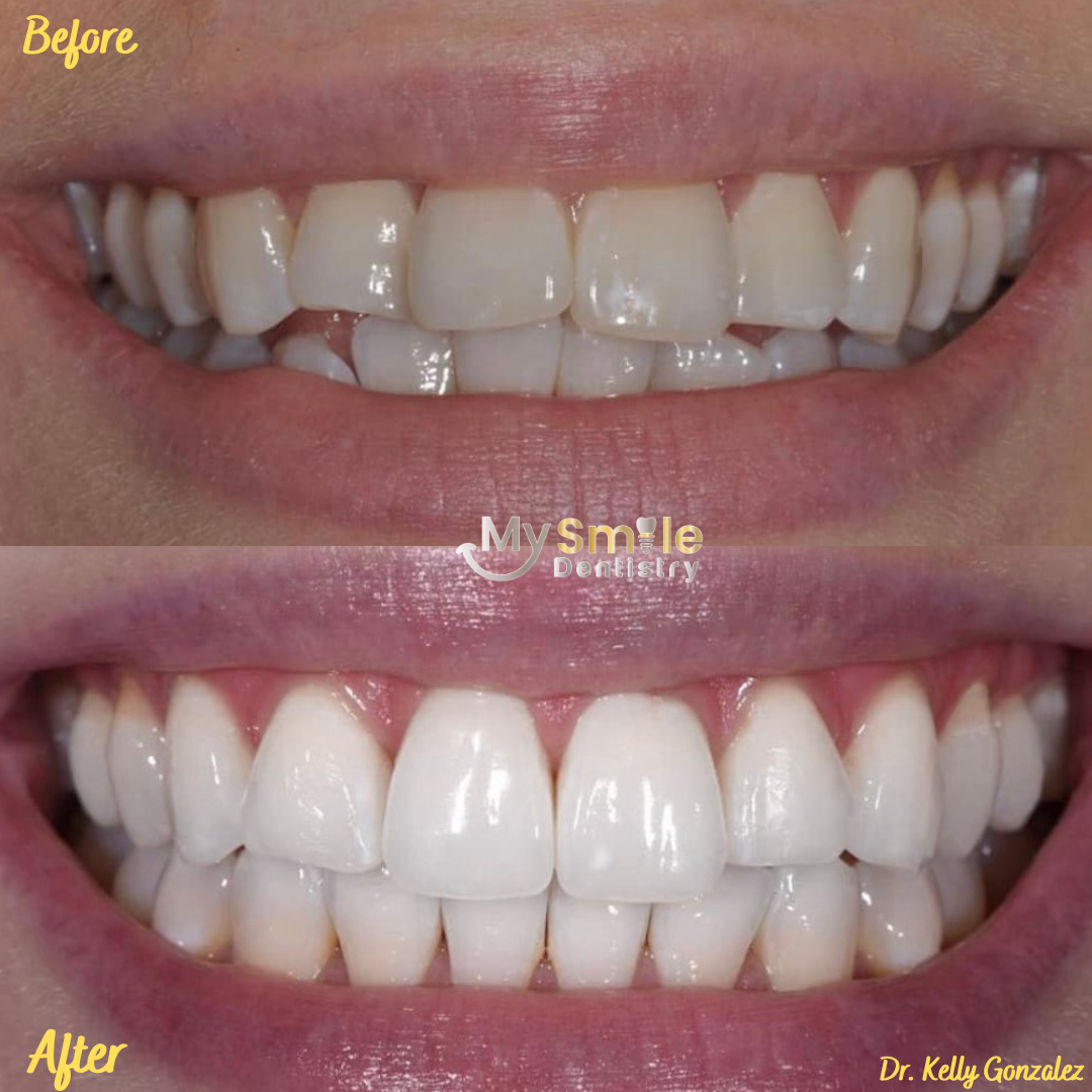 My Smile Dentistry | Implant-Supported Dentures, Fillings and Root Canals