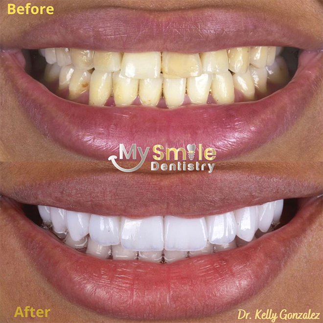 My Smile Dentistry | Veneers, Laser Gum Surgery and Dentures