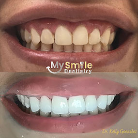 My Smile Dentistry | Sedation Dentistry, Digital Impressions and Sports Mouthguards