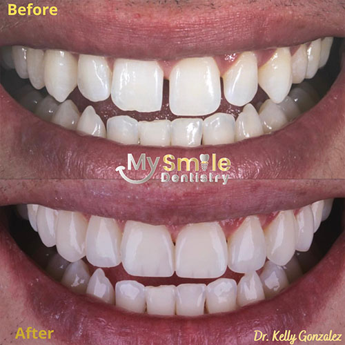My Smile Dentistry | Orthodontics, Laser Gum Surgery and Lumineers reg 