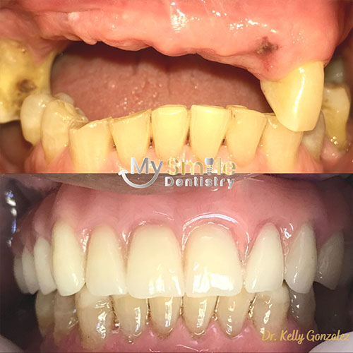 My Smile Dentistry | Laser Gum Surgery, Invisalign reg  and Aligners and Implant-Supported Dentures